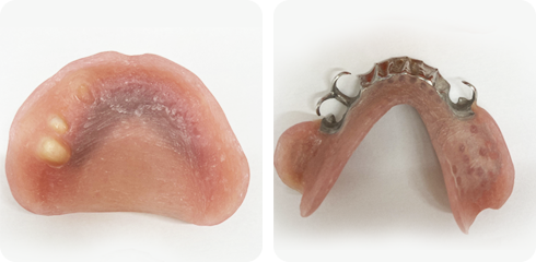 入れ歯の歯と歯茎部分の制作
